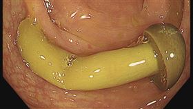 金針菇＝明天見！ 醫曝大腸鏡：整朵菇類排出來
▲大腸內完完整整的一根鴻禧菇相當清楚。（圖／翻攝自胰臟醫師林相宏臉書）

