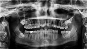 ▲牙齒 頭骨 顱骨 古代牙齒 牙齒模型 腐爛牙齒 看牙 口腔 張大嘴 看牙醫。（圖／翻攝自Pixabay）