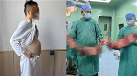 便秘4月沒排便！他腹部腫大「如懷胎10月」　開刀取出10公斤重壞死結腸