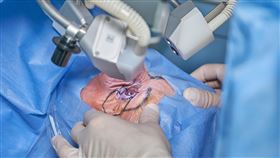 眼睛手術。（示意圖／PIXABAY）