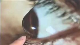▲一名男子就醫檢查發現角膜變圓錐形，醫師問診發現病患有揉眼睛習慣，長期摩擦導致角膜變形。（圖／翻攝自微博）