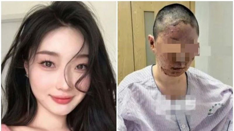 父點菸氣爆！女網紅毀容拍片籌醫療費遭酸