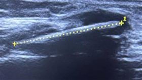 ▲醫生發現，導致患者不適的原因是一根16年前扎入肉裡的竹籤。（圖／翻攝自三湘都市報）

