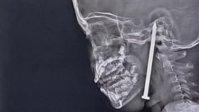 印度,鐵釘,腦部,手術（圖／翻攝自X）