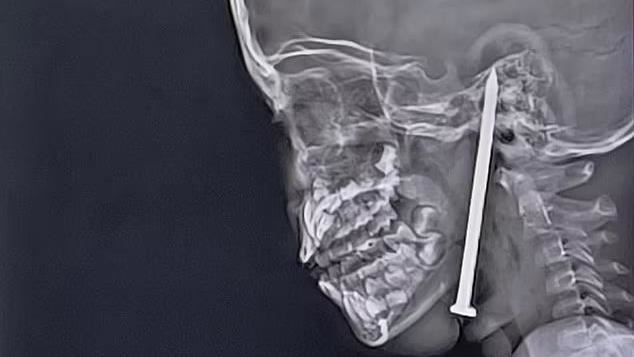 7歲男童玩耍跌倒　「8公分」鐵釘灌入腦門