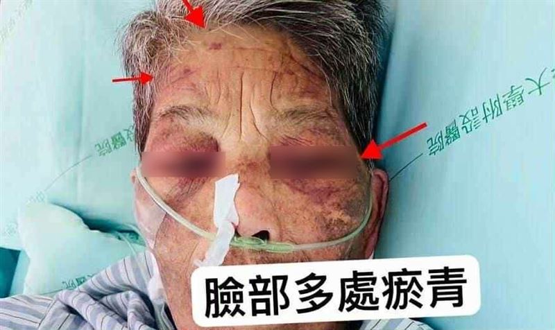 台中85歲阿嬷臉上身上滿是瘀青，家屬事隔3個月才知道是遭外籍看護施暴。(圖／翻攝畫面)