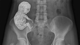 胎死腹中30年！偏鄉孕婦難就醫 74歲肚痛產下「石胎」（圖／翻攝自Medicina Clinica臉書）
https://www.facebook.com/share/p/1AqZPkCaJk/