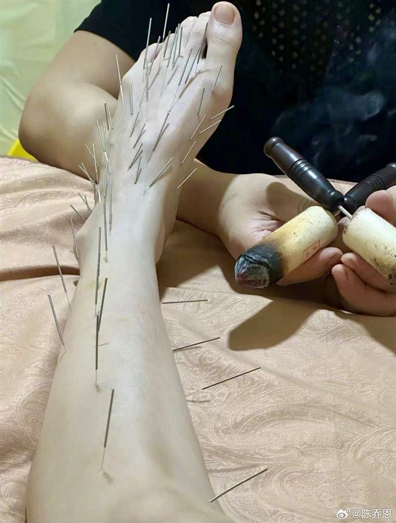 陳喬恩全身插滿密密麻麻的針。（圖／翻攝自陳喬恩微博）