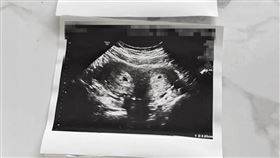  A女因聽到男友喬天鼎的偷吃傳聞，影響情緒而流產。圖為她當時懷孕的超音波。（讀者提供）