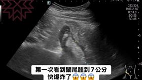 她胃超痛　醫驚：第一次看到闌尾腫成7公分！快爆炸　圖／林相宏臉書