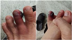 腳趾被馬陸咬，腫成可麗露（圖／翻攝自當事人臉書）