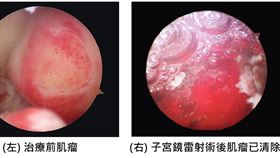 肌瘤手術前後對比照。（圖／聯新國際醫院提供） 