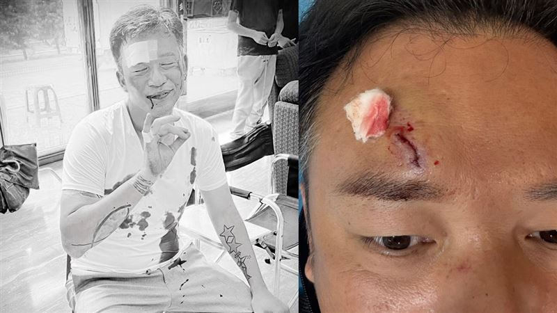 45歲男星拍戲出事「滿身是血」送醫急救