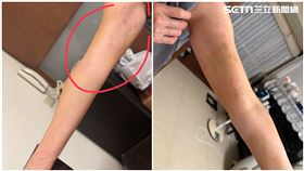 獨家／1個月挨6針類固醇！60多歲婦控「全身痛如玻璃娃娃」院方回應了（圖／當事人提供）