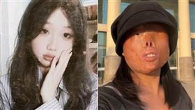 慎入！女被前夫潑硫酸「眼睛溶掉」毀容　所幸遇貴人得重生（組合圖／翻攝自抖音）