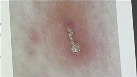 醫師表示，對患者進一步透過皮膚鏡檢查，可見典型的「蟲隧道」，並在皮膚刮屑中發現疥蟲。（圖／記者簡浩正攝影）