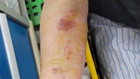 民眾誤信偏方導致傷口潰爛發炎，險釀蜂窩性組織炎。（圖／雙和醫院提供）