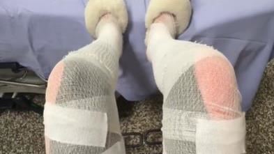 女烈日去玩水「整條腿燒傷」痛7天無法走