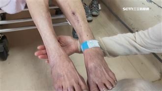 獨／8旬嬤疑遭外傭施暴 親家是小琉球網紅