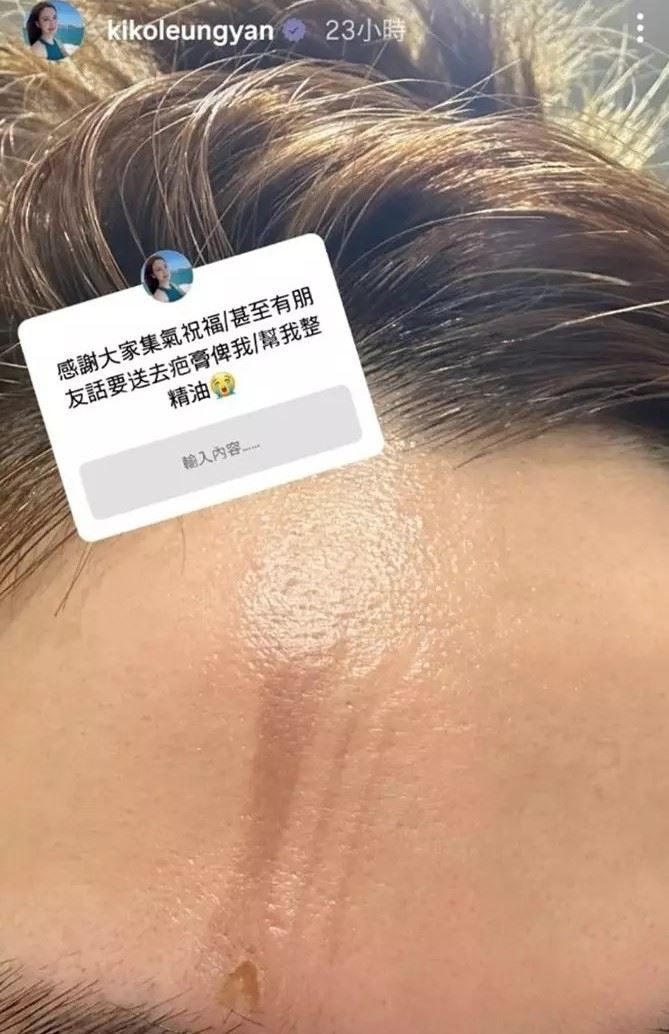 梁茵傷勢曝光。（圖／翻攝自梁茵IG）