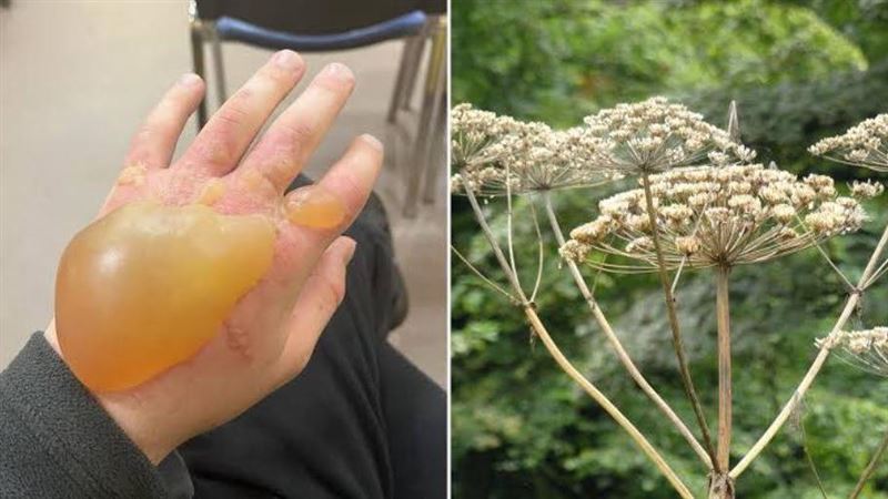 危險毒植物入侵北海道！手一碰腫巨大水泡