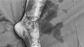 暑假打工,燙傷,陽光基金會