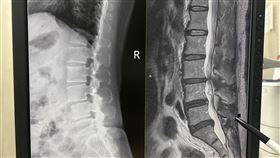 經MRI檢查發現患者腰椎第3、4、5節椎間盤突出壓迫神經造成腰痛、腳麻。（圖／高雄中正脊椎骨科提供）