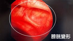 李聖偉醫師提醒，攝護腺肥大很容易造成膀胱變形（圖／中國醫藥大學新竹附設醫院提供）