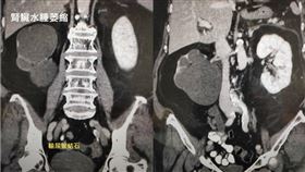 60歲婦人「忽視輸尿管結石」賠掉右腎！醫嘆：只剩薄薄一層／呂謹亨臉書