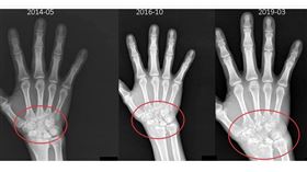 以為不會痛就沒事！類風濕關節炎變骨侵蝕（圖／翻攝畫面）