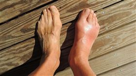 ▲一名63歲婦人腳腫到發紫，轉至台東馬偕醫院後，竟被診斷為嚴重深層靜脈血栓。（示意圖／PIXABAY）
來源 新媒體