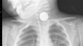 幼童吞電池食道破損　家長應嚴防小物一名2歲女童日前深夜嘔吐、流口水，急診檢查發現，女童食道卡著一枚鈕扣電池。醫院雖緊急動刀取出，但女童的食道已經破損，必須靠鼻胃管餵食至少3個月。（林口長庚醫師吳昌騰提供）中央社記者陳偉婷傳真　107年5月20日