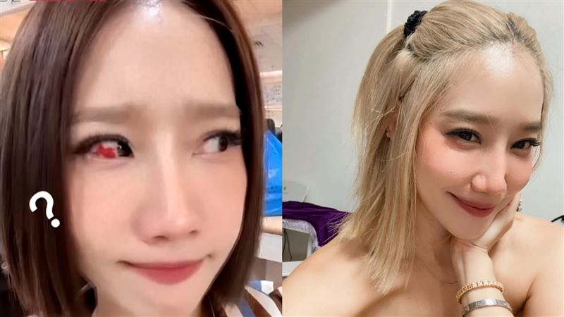 無徵兆爆血輪眼　楊皓如看遍醫生查無原因