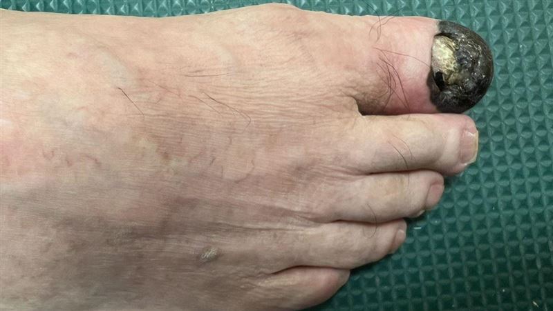 以為拇指只是撞傷瘀青而已　結果竟是罹癌