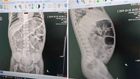 ▲男童靠生殖器大便近5年，「涓涓細流」讓腹中堆滿宿便。（圖／翻攝自驣訊網）
