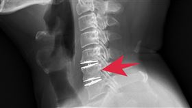 老總拉「頸」報！手腳麻痛醫失眠1招解決(圖/翻攝畫面)