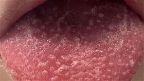 病人出現典型的草莓舌。（圖／台北慈濟醫院提供）