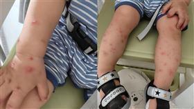 ▲男童被親之後，全身出現紅疹腫包。（圖／翻攝自封面新聞）