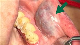 良性口腔血管病變常在舌、頰黏膜、口底等部位出現紅紫或藍紫色外觀(箭頭所示)。(圖／長庚醫院提供) 