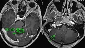▲基隆一名肺癌癌末患者，肺癌轉移到腦變「滿天星」至少有10顆腫瘤。醫師警告：忽略1關鍵-暴瘦，小心一有症狀就是癌症末期。（圖／經家屬同意、基隆長庚醫院提供） 