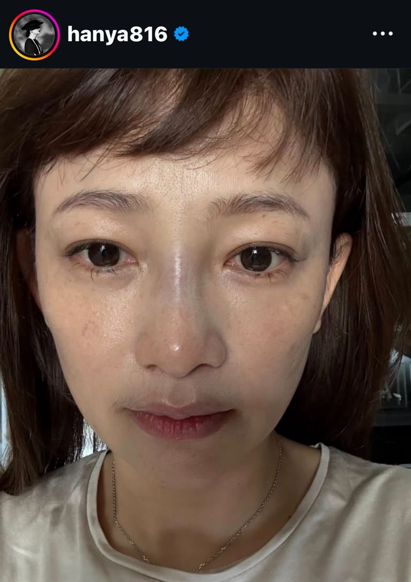 張涵雅遭受兒子頭部強力撞擊,導致鼻樑骨折緊急送醫。(圖/翻攝自張涵雅IG)