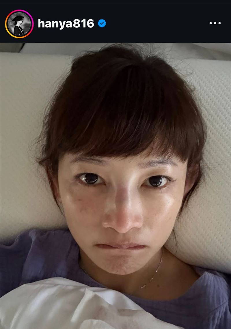 張涵雅遭受兒子頭部強力撞擊,導致鼻樑骨折緊急送醫。(圖/翻攝自張涵雅IG)