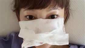 張涵雅遭受兒子頭部強力撞擊，導致鼻樑骨折緊急送醫。（圖／翻攝自張涵雅IG）