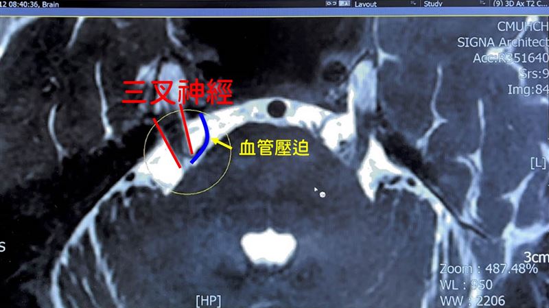 60歲男臉部出現如電擊般劇痛,連風吹都難忍,確診三叉神經痛。經手術治療後,終於擺脫長年折磨。(圖/中國醫藥大學新竹附設醫院提供)