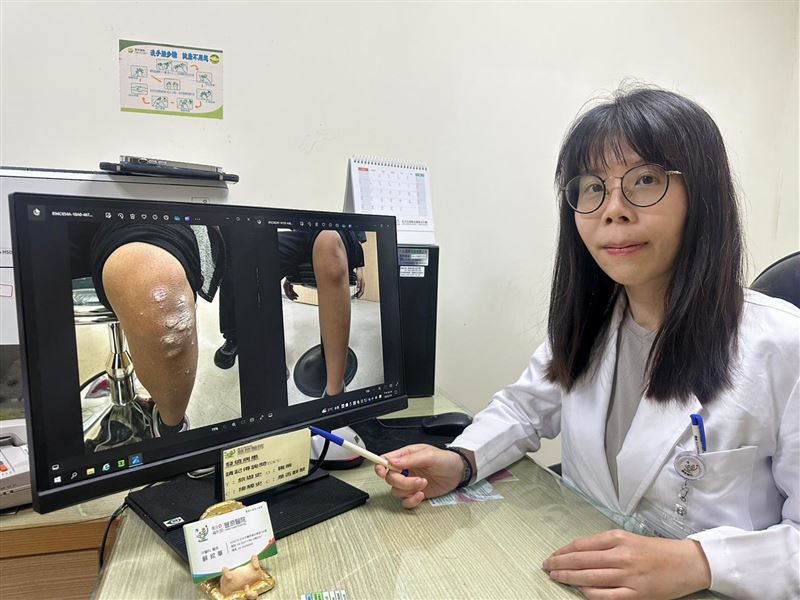12歲女童的關節處出現乾癬,奇癢無比甚至到無法入睡的程度。(圖/省立豐原醫院提供)
