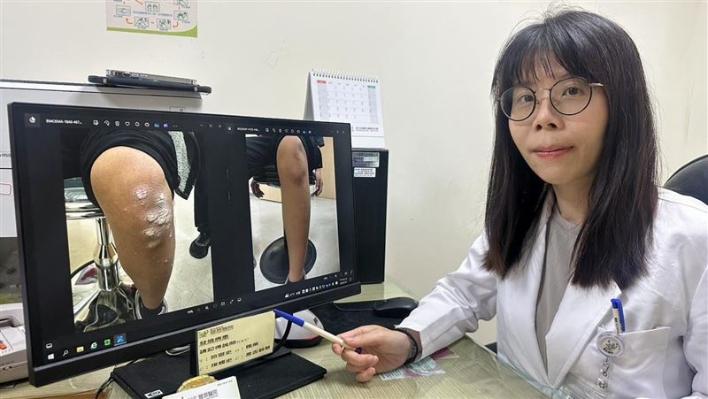 手腳脫屑「奇癢」無法入睡　女童竟染乾癬