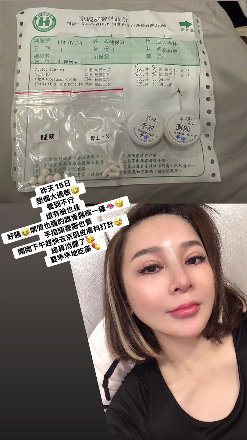 王彩樺坦言自己全身過敏,臉部也因此浮腫。(圖/翻攝自王彩樺IG)