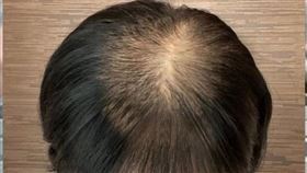 唐玲回憶罹癌時，曾大量掉髮禿頭變河童。（圖／翻攝自唐玲IG）