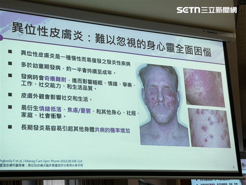 醫師指出.異位性皮膚炎是和體質有關且長期處於發炎狀態的「慢性病」。(圖/記者簡浩正攝影)