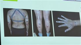 黃小姐病情嚴重時，甚至病灶遍及全身從頭到腳。（圖／記者簡浩正攝影）